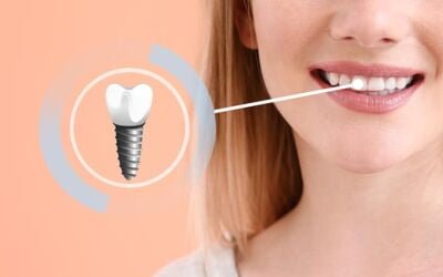 Common Questions about Dental Implants