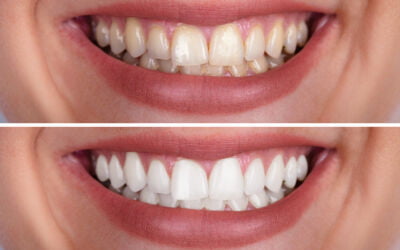 How Much Does Teeth Whitening Cost?
