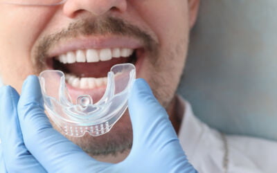 What Are Mouthguards? Collingwood Dentist Weighs In