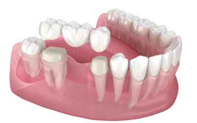 How Long Does It Take To Recover From A Dental Bridge Procedure?