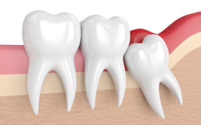What Causes a Wisdom Tooth to Become Impacted?