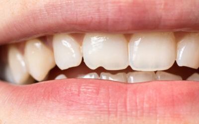 How to Handle Chipped or Broken Teeth?