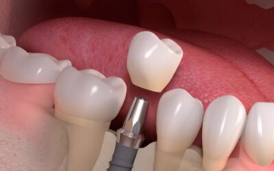 How to Maintain Your Dental Implants: Essential Tips for Long-Lasting Results