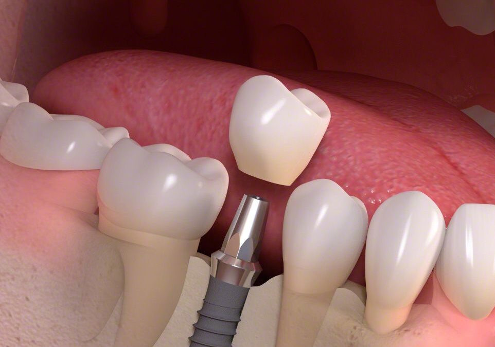 dental implants in Collingwood