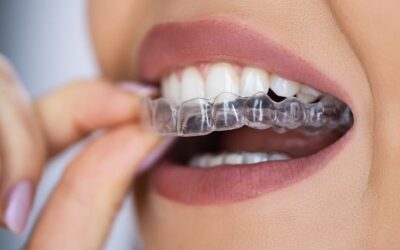 Invisalign in Collingwood: How Long Does It Take to See Results?