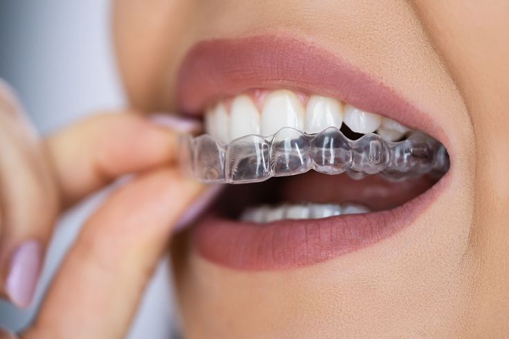 Invisalign in Collingwood