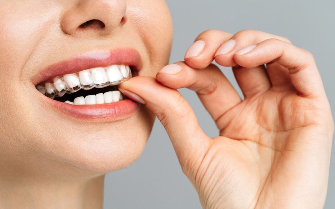 Invisalign and Oral Hygiene: Keeping Teeth Healthy During Treatment