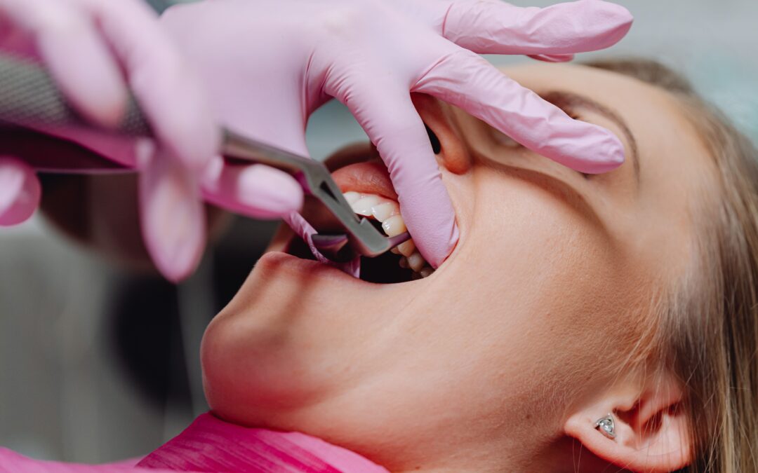 Wisdom Teeth Extractions Collingwood